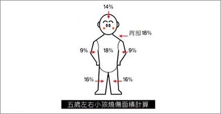 烧伤面积是如何估算的?