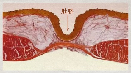 法医下刀时,为什么要绕开肚脐眼?