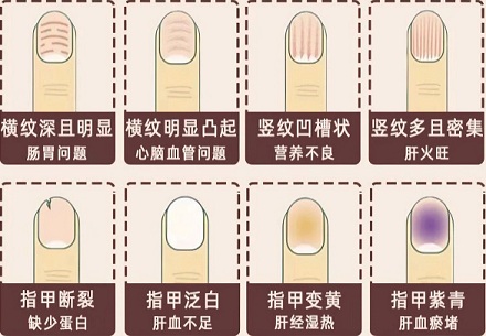 指甲上没月牙是营养不良吗？