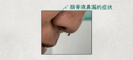 为什么尝到鼻涕变得甜甜的必须马上去医院?