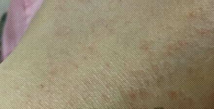 为什么很多对芒果过敏的人，往往也不能吃腰果和开心果？