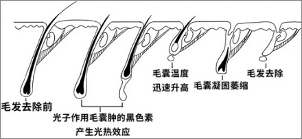 为啥黑人不能用脱毛仪?