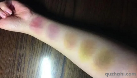 淤青的颜色为什么会变化?